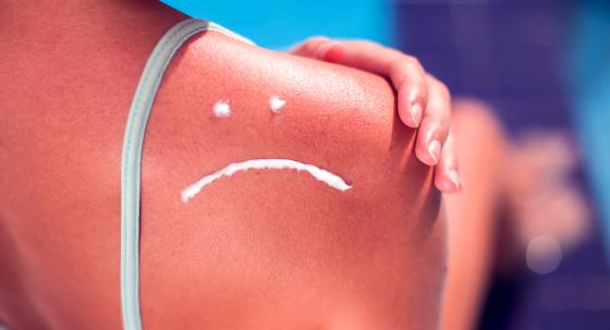 Sonnenbrand